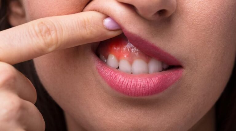 Cómo curar encías lastimadas por prótesis dentales