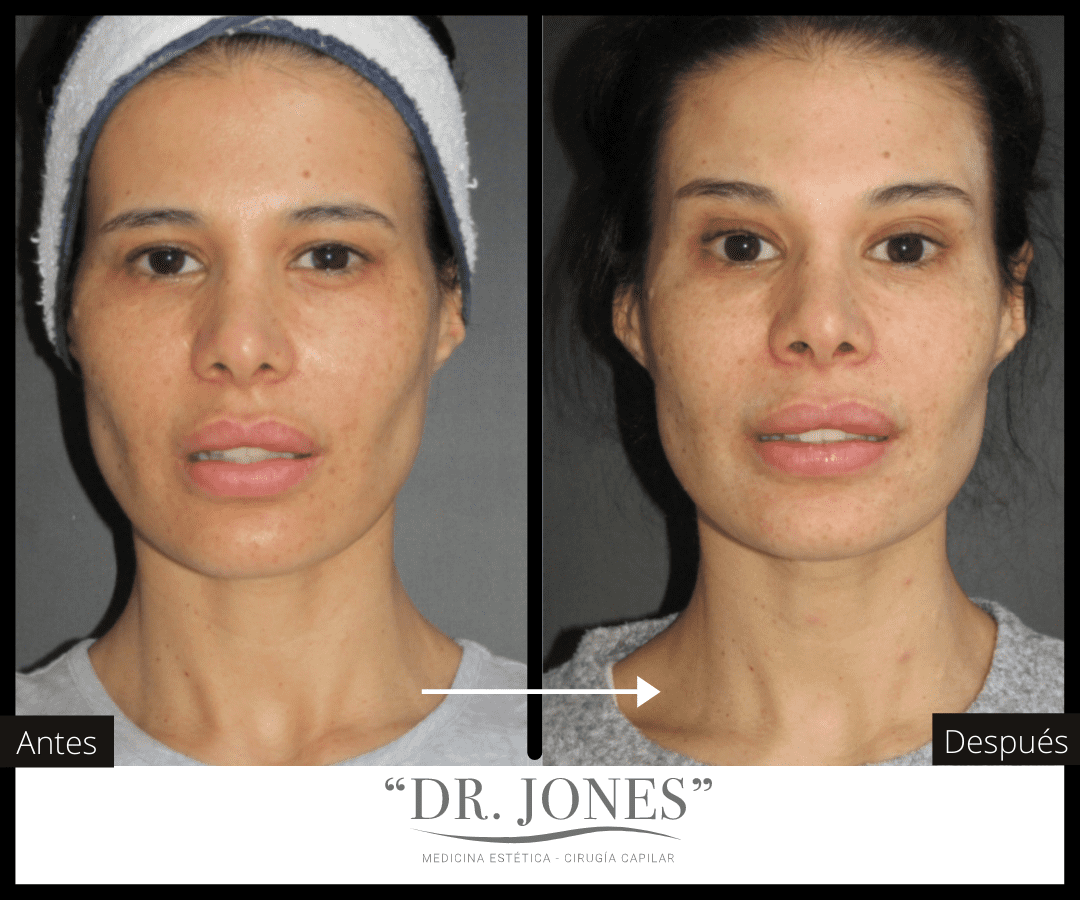 cuales son los resultados del plasma en la cara antes y despues