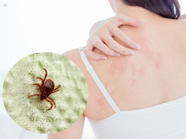 Cuáles son los síntomas de la alergia a los ácaros del polvo