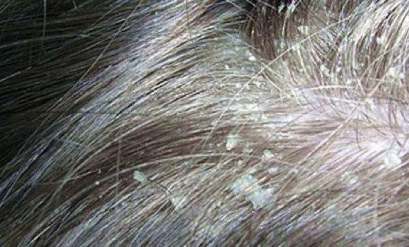 por que mi perro tiene caspa blanca y como puedo tratarla